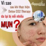 Vì sao sau khi thực hiện detox da CO2 Therapy da lại bị nổi nhiều mụn.Sapphirebeauty