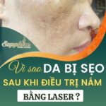 Vì sao da bị sẹo sau khi điều trị nám bằng laser?