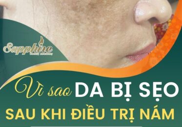 Vì sao da bị sẹo sau khi điều trị nám bằng laser?
