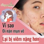 Vì sao đi nặn mụn về khách lại bị viêm nhiều hơn??