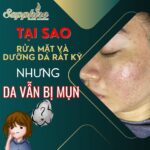 Tại sao rửa mặt và dưỡng da rất kỹ nhưng da vẫn bị mụn