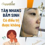 Tàn nhang bẩm sinh có điều trị được không??