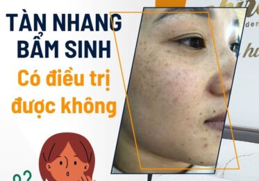 Tàn nhang bẩm sinh có điều trị được không??