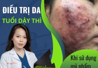 Điều trị da tuổi dậy thì khi sử dụng mỹ phẩm sai cách