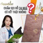 Chấm sẹo rỗ tại nhà có hết thật không ???