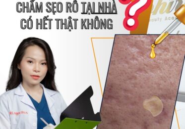 Chấm sẹo rỗ tại nhà có hết thật không ???