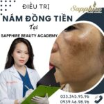 Điều trị nền da nám đồng tiền tại Sapphire Beauty Academy